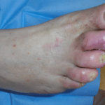 Piede-diabetico