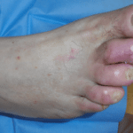 Piede-diabetico-aspect-ratio-535-375