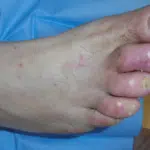 Piede-diabetico-aspect-ratio-535-375